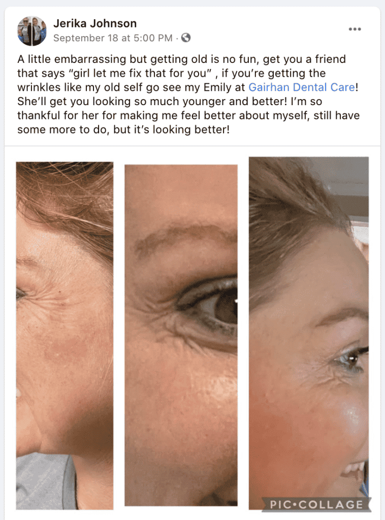 before and after botox jonesboro ar 758x1024 - Before and After Botox: Here's What Jerika Has to Say!