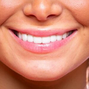 Veneers Gairhan Dental Care Jonesboro AR 2022 3 300x300 - Dental Veneers